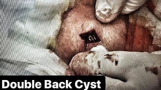 Double Back Cyst!  Epidermoid Cyst Removal, Dr. John Gilmore