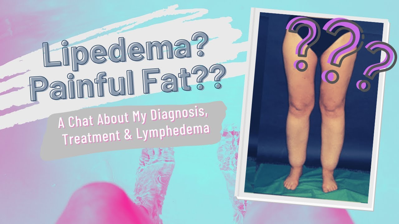 My Lipedema Story: Diagnosis, Treatment, & Lymphedema