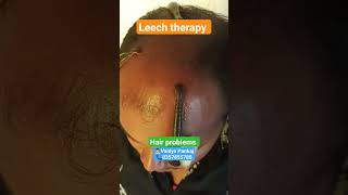 Hair fall treatment leechtherapyhirudutherapy bamsayurvedashortstrendingindiaviralhair
