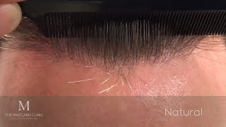 1878 FUE Hair Transplant, Dr  Ball, High density,  Natural Hairline