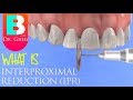 Interproximal Reduction (IPR) Stripping of Teeth for Braces or Invisalign