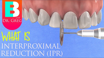 Interproximal Reduction (IPR) Stripping of Teeth for Braces or Invisalign