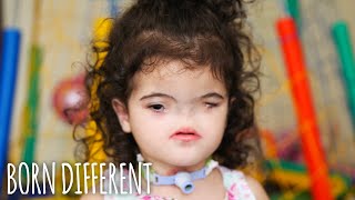 The Little Girl Born With No Nose | BORN DIFFERENT