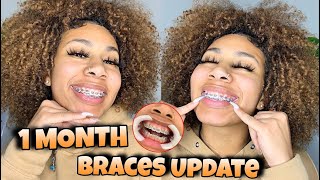 1 MONTH BRACES UPDATE +BOTTOM BRACES + NEW COLOR??| KDiani screenshot 2