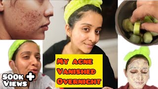 How to Make Your Acne Disappear Overnight | 4 Home Remedies For Pimples