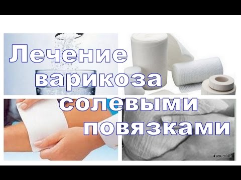 Солевые повязки при варикозе. Лечение солью. AyurClub