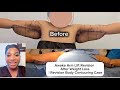 Awake Arm Lift Revision After Weight Loss | Revision Body Contouring Case