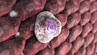 Vs embolia ataque cardíaco pulmonar