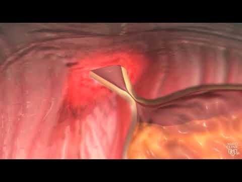 Video: Hiatal Hernias Og Acid Reflux