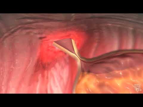 Vidéo: Hernies Hiatales Et Reflux Acide