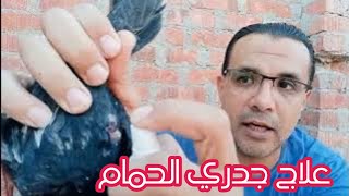 علاج جدري الحمام بطريقه سهله