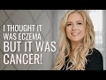 Itchy skin to lymphoma  miranda  hodgkins lymphoma  the patient story