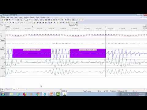 Natus PSG Webinar: Case Study Scoring Respiratory Events