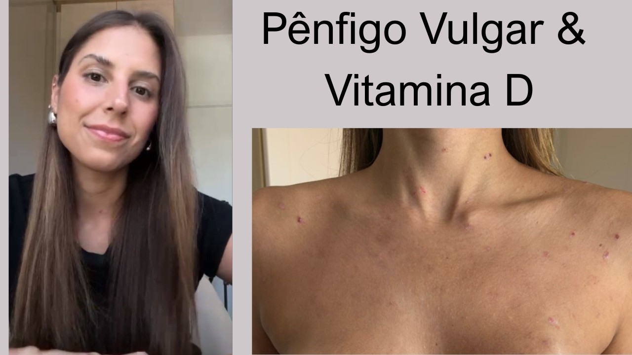 Giovana - Pênfigo Vulgar #1121