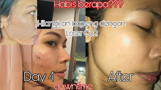 Laser CO2 Fractional | Laser bopeng