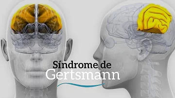¿Qué es el síndrome de Gerstmann?