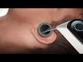 TymCure solution for tympanic membrane perforations