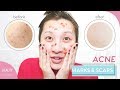 Remove Acne Marks, Hyperpigmentation & Scarring | Home Remedies + Natural Ingredients to Use