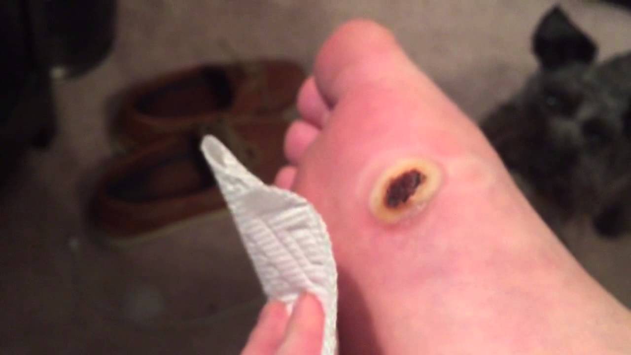 Wart on foot or blister. Do warts on foot itch - mexgazservice.ro - Wart on foot with pus