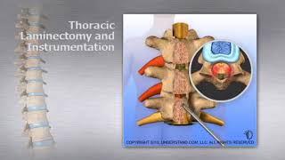 Thoracic   Thoracic Laminectomy and Instrumentation
