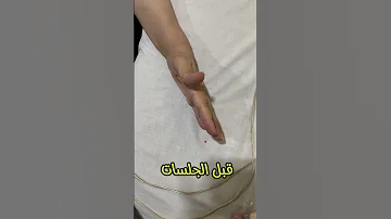 علاج تيبس أصابع اليد 