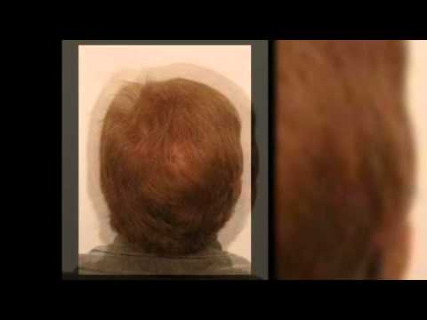 Procerin Reviews