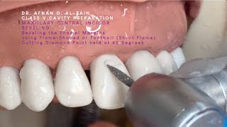 Class V cavity preparation for composite on a maxillary central incisor (#11) - Arabic عربي