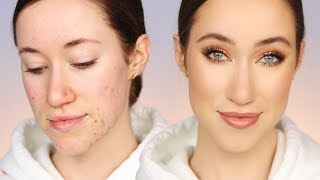 How I Cover My Acne (All Drugstore Makeup)