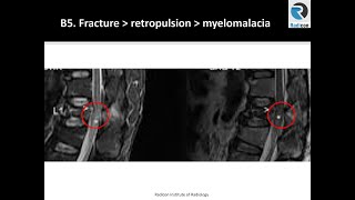 Lumbar Spine Mri Part 8 Conus - Fractures And Cord Contusion