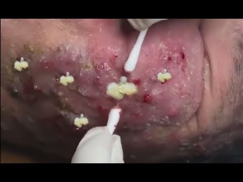 How to Remove acne on face and  Pimple Popper Videos  and  relaxing music Sunshine Samba