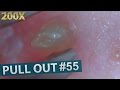 #55 Pull Out Blackheads Close up 200X - Blackheads Removal