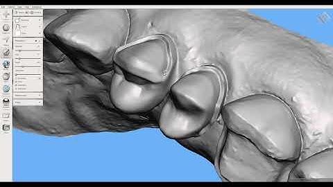 Video 9: Preparación biomecánica en Meshmixer