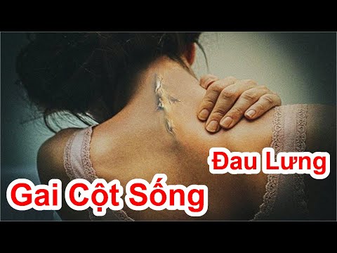 GAI CỘT SỐNG - Đau Lưng Có Nhiều Người Làm Hết Bạn Nên Thử Xem Sao / Cách Trị Gai Cột Sống Đau Lưng