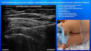 Ultrasound Guided Greater Trochanteric Bursitis Injection In A 64 Year Old Female