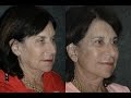 Facelift Surgery &amp; Eyelid Ptosis Repair for 67 Year Old Woman | Dr Andrew Jacono Reviews