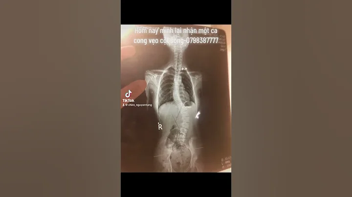 Điều trị cong vẹo cột sống tại Hà Nội-0798387777