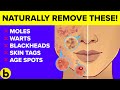 Destroy Your Moles, Warts, Blackheads, Skin Tags And Age Spots Completely Naturally