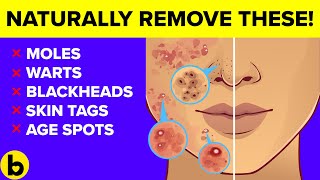 Destroy Your Moles, Warts, Blackheads, Skin Tags And Age Spots Completely Naturally