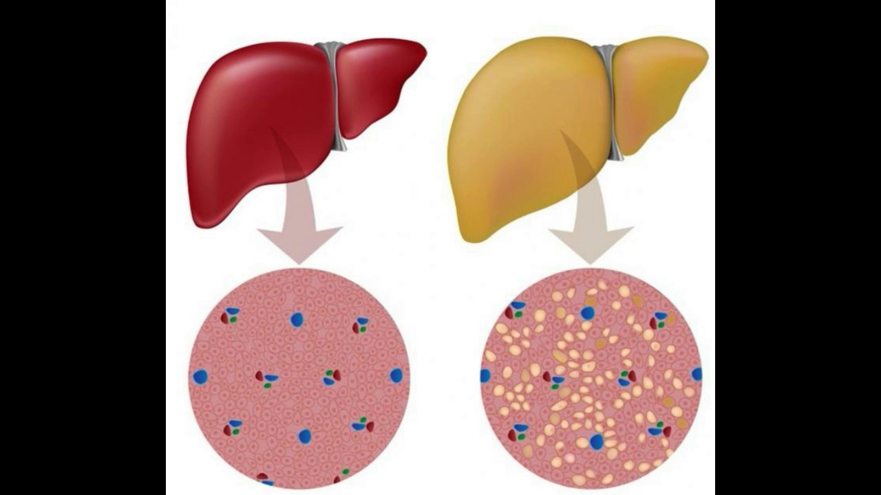 Жировое увеличение печени