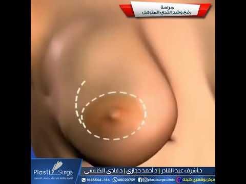 جراحة رفع وشد الثدي المترهل 