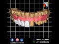 Masculine shape    qualident dental lab