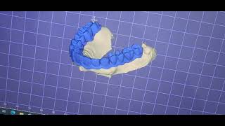 #exocad library training zirconia cad cam design 