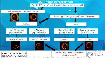 OCT-guided PCI: step-by-step_Shlofmitz_Coronary On Demand