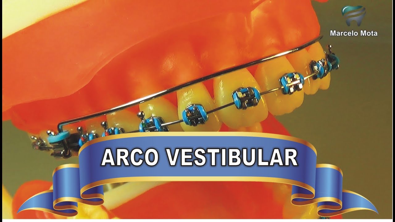 ARCO VESTIBULAR ACESSÓRIO (para expansão dentoalveolar)