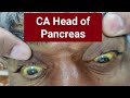 Ca head of pancreas jaundice itching and weight loss