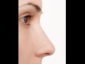 Rhinoplasty