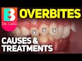 Deep Overbite Bite & Braces: Causes and Correction / Orthodontic Treatments