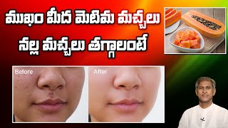 Face Pack for Acne, Dark Spots and Glowing Skin | Skin Care Tips | Dr.Manthena's Beauty Tips