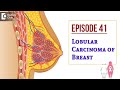 Lobular Carcinoma Of Breast | Milk producing gland Cancer-Dr.Sandeep Nayak|Samrohana|Doctors