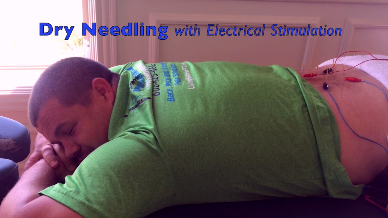 Electro Dry Needling – EP Bodywork Therapy